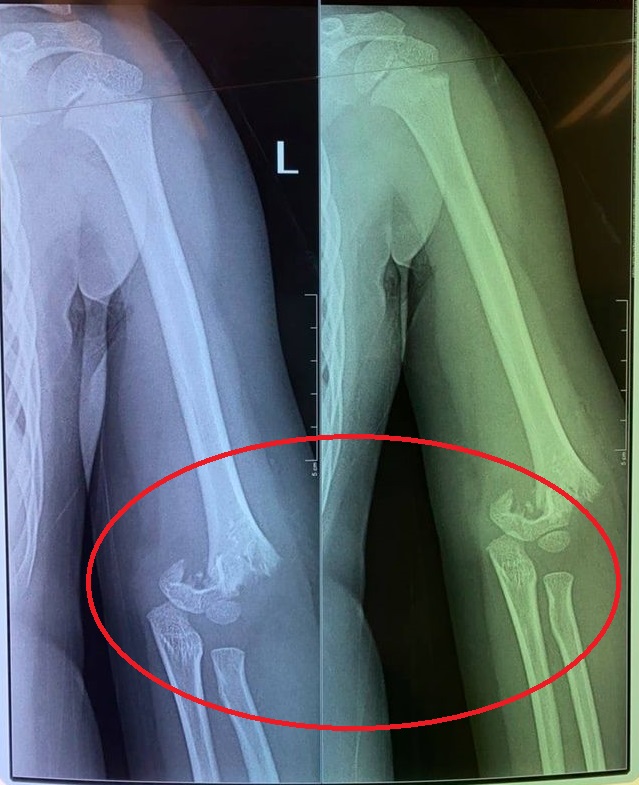 Con chị H. bị bạn đẩy ngã gãy tay.