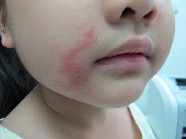 Khi bị dính độc tố của kiến ba khoang, điều mọi người nên làm ngay là lấy nước sạch mát rửa chỗ kiến đốt rồi cho xà phòng vào rửa cùng.