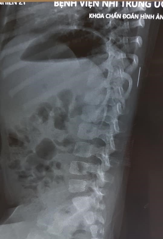 Hình chụp X-quang