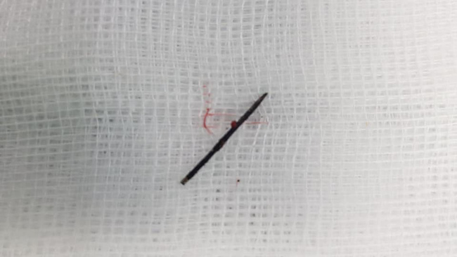 Ca phẫu thuật diễn ra trong 1 tiếng đã lấy ra 1 dị vật là ½ chiếc kim khâu dài 17mm đã bị gỉ đen.