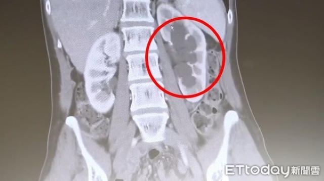 Cô Thục đến khám tại một bệnh viện và được chẩn đoán là phù thận.