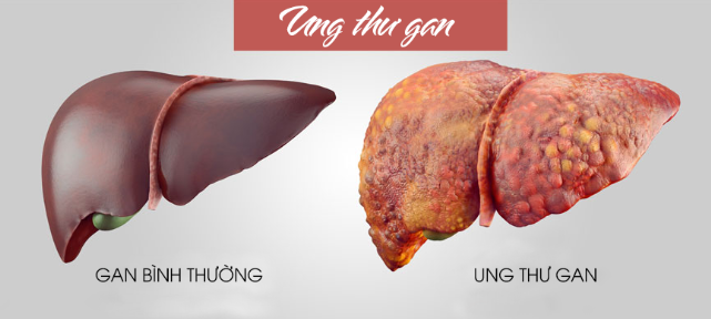 Hình ảnh ung thư gan