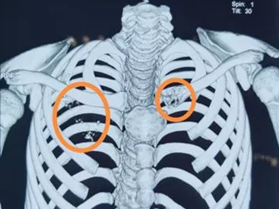 Những trường hợp bị ung thư phổi như cậu bé này rất hiếm (Ảnh minh họa).