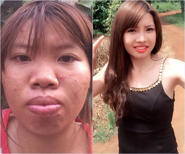 Hình ảnh Phượng Thị Nở trước và sau khi phẫu thuật.