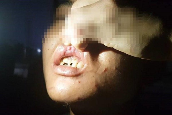 Một trong 2 cậu bé bị gãy răng (Ảnh: Danviet)