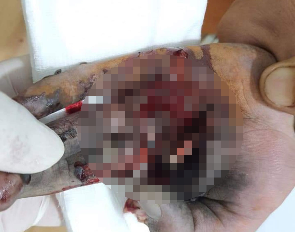 Bàn tay nạn nhân nát bét vì điện thoại bị nổ sau khi vừa xạc vừa chơi games.