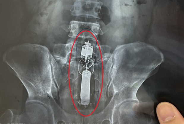 Sextoy kẹt trong trực tràng nam thanh niên.