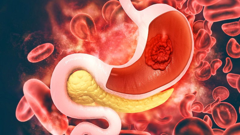 Các bệnh nhân ung thư dạ dày thường có tỷ lệ nhiễm H. pylori cao hơn những người không bị ung thư dạ dày.