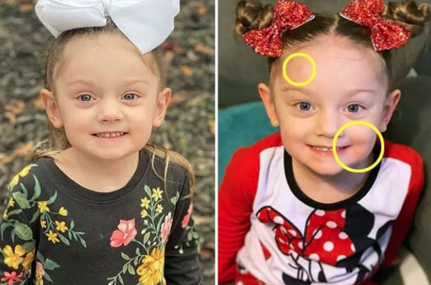 Dân mạng tinh mắt nhận ra trên gương mặt của bé Victoria có nhiều dấu vết đáng ngờ.