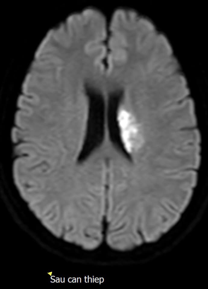 Hình ảnh sau can thiệp