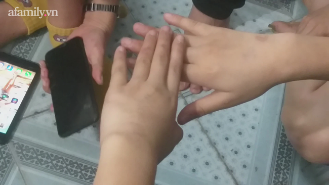 Những vết thương vẫn hằn trên tay cháu B