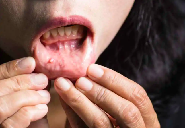 Nếu là ung thư miệng thì vết thương khó lành, vết loét sẽ ngày một phát triển, khó lành, dễ tái phát.