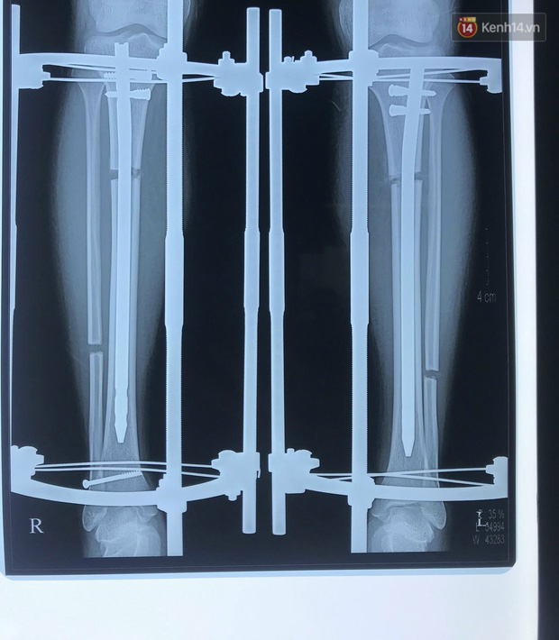 Chân của Tâm sau ca mổ, có thể thấy rõ từng đoạn gãy rời