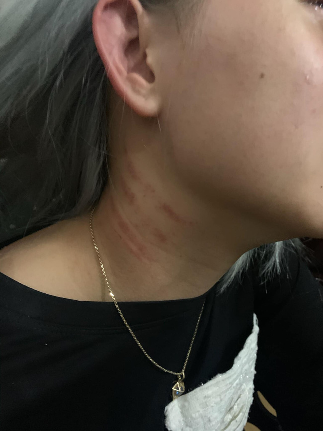 Dấu vết bị bóp cổ của cô vợ.