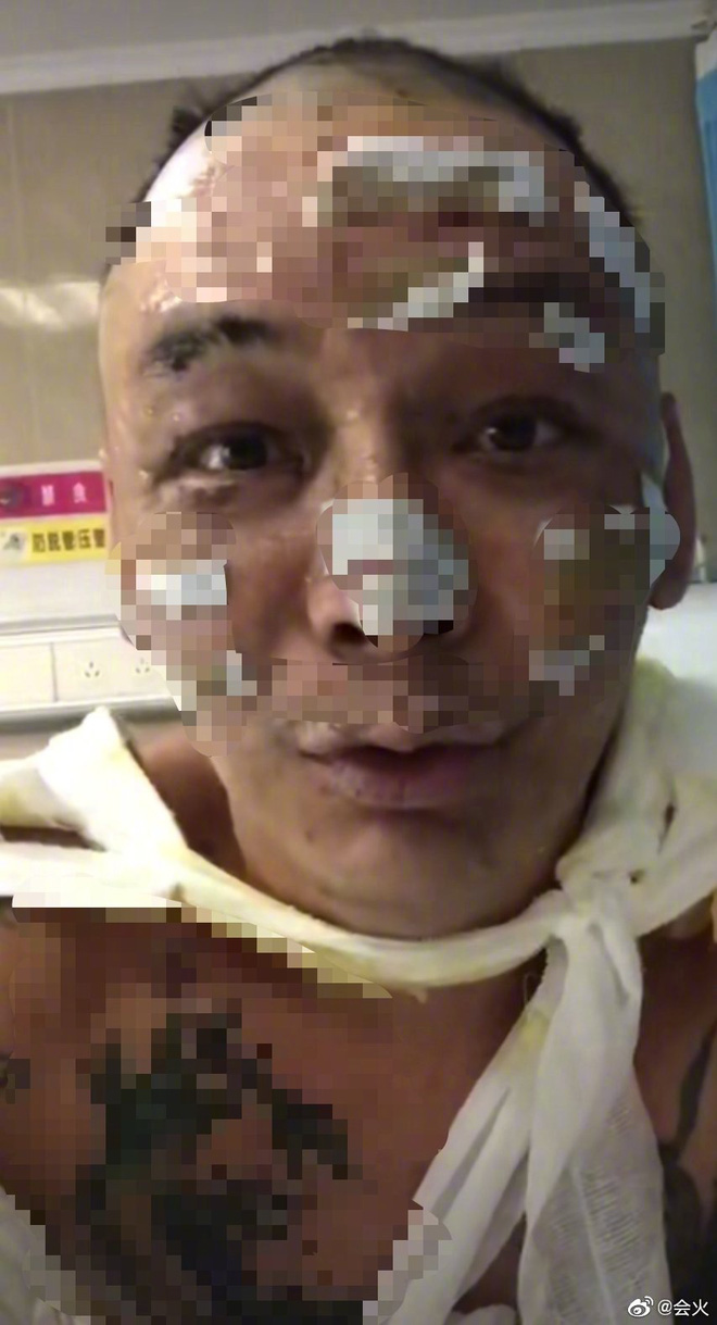 Từ một ca sĩ sở hữu gương mặt khá điển trai và nam tính, vậy nhưng giờ đây Từ Chân Chân đang phải điều trị tích cực vì bỏng nặng khiến mặt biến dạng