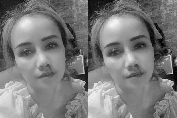 Diễn viên Hoàng Yến bị chồng cũ bạo hành dẫn tới gẫy xương mũi