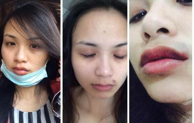 Diễm Hương công khai những vết tích trên gương mặt do bị chồng cũ bạo hành