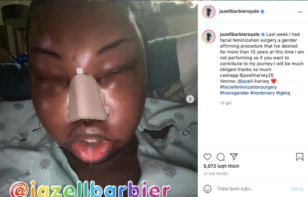 Hoa hậu Chuyển giới Quốc tế 2019 bất ngờ công khai phẫu thuật thẩm mỹ, gương mặt biến dạng đến khó tin