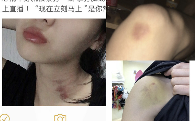 Cô gái nhận mình là bạn gái nam ca sĩ tung loạt ảnh bị bạo hành với những vết thâm tím khắp cơ thể