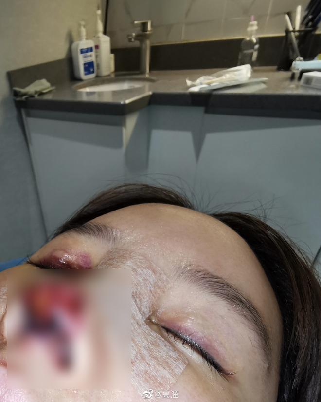 Những tấm hình trong và sau quá trình phẫu thuật của Cao Lưu khiến MXH dậy sóng