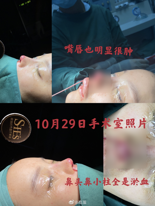 Toàn bộ hình ảnh từ quá trình phẫu thuật cho đến khi vùng da xuất hiện dấu hiệu hoại tử được Cao Lưu chia sẻ trên MXH