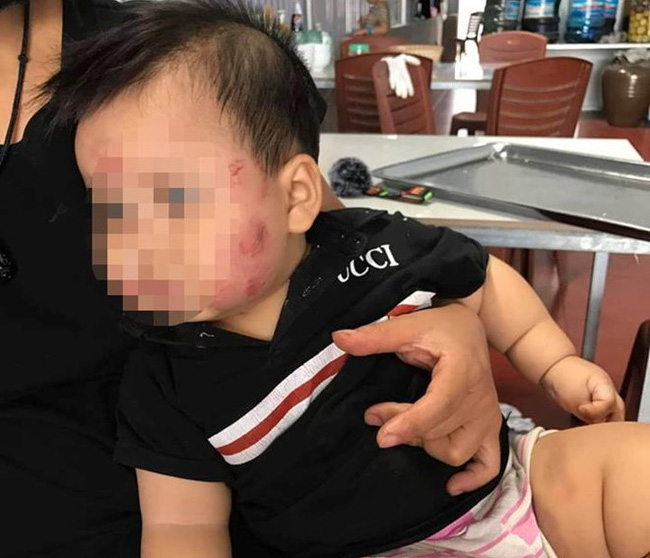 Cháu M bị bầm tím người với nhiều vết được giải thích là 