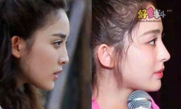 Người đẹp bị phát hiện phẫu thuật thẩm mỹ phần mũi