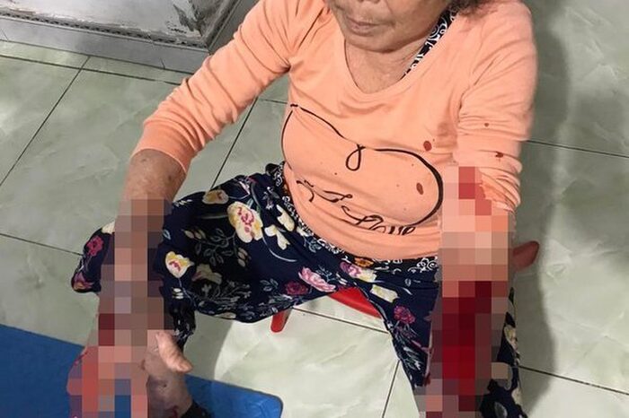 Bà Hội bị thương tích nặng sau vụ việc. Ảnh: VietNamNet