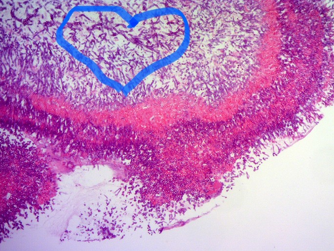 Hình ảnh nấm Aspegillus fumigatus trên tiêu bản nhuộm soi giải phẫu bệnh