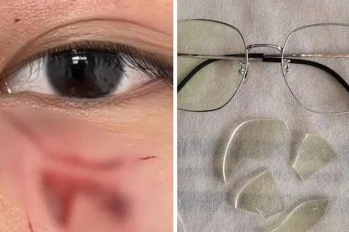 Vết thương dưới mắt và chiếc kính vỡ của nam sinh do bị thầy giáo Vật lý đánh.