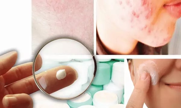 Bôi kem trộn chữa trứng cá ghi nhận nhiều ca gặp nạn đáng sợ.