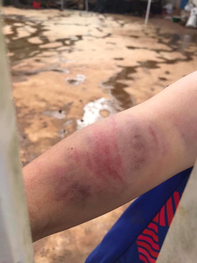 Những vết bầm tím khắp cơ thể