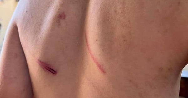 Cháu bé 9 tuổi bị cha và bà nội đánh đập dã man