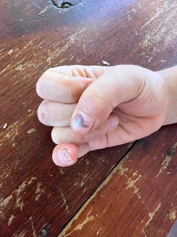 Mẹ cháu bé cho rằng bà nội đã dùng búa đinh đập vào đầu các ngón tay khi cháu lấy 1 gói mì tôm ăn mà không xin phép