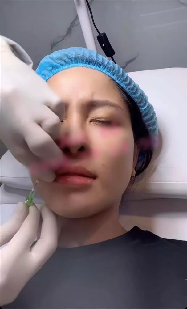 Đây là phương pháp làm đẹp không quá phức tạp như phẫu thuật nhưng nhiều người không khỏi rùng mình trước cảnh Trâm Anh cắm kim vào mặt...
