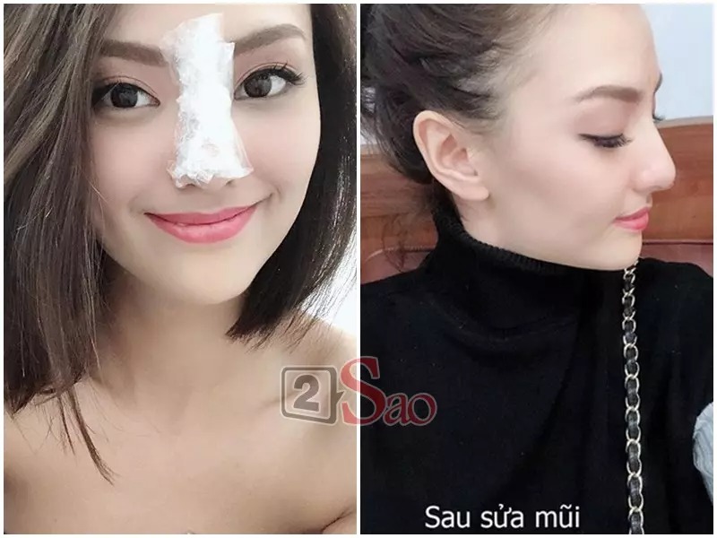 Hồng Quế làm mũi để thay đổi ngoại hình và mong đổi vận để cuộc sống thuận lợi, may mắn hơn. 