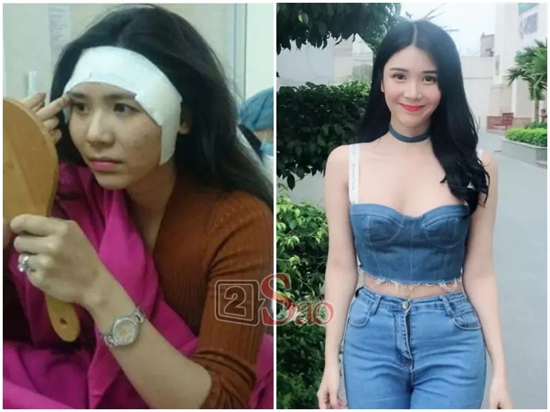 Thanh Bi được cho đã phẫu thuật độn thái dương. Loạt ảnh từ lúc cô nằm trên bàn giải phẫu cho đến khi ca phẫu thuật hoàn thành với vùng băng bó ở thái dương được mô tả là 