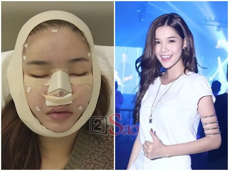 Kỳ Hân thừa nhận từng sửa mũi hai lần và làm lại răng. Cô cho biết tổng chi phí làm đẹp rơi vào khoảng 250 triệu đồng.