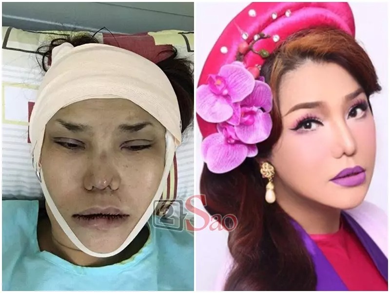 Ca sĩ chuyển giới Cindy Thái Tài cũng mạnh dạn chia sẻ những hình ảnh khi vừa sửa mũi lần thứ 5, cắt mí mắt, làm lại môi và nâng cơ mặt để có diện mạo trẻ trung, hấp dẫn hơn.