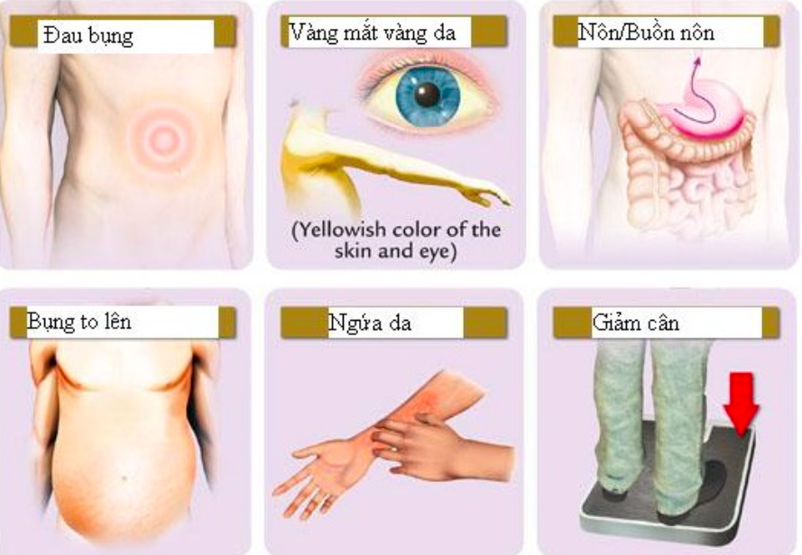 Một số triệu chứng ung thư gan. Nguồn: Bệnh viện K