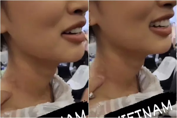 Một clip hậu trường được netizen truyền tay nhau mới đây đã hé lộ tình trạng đáng lo ngại của người đẹp sau đêm Bán kết. Cụ thể, Thiên Ân đã chia sẻ vết thương ở cổ do chiếc váy ôm sát gây ra.