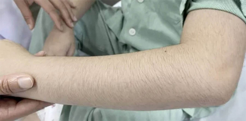 Bé H. bị suy tuyến thượng thận do dùng thuốc xịt tai mũi họng có corticoid dài ngày không theo hướng dẫn. Ảnh: BVCC