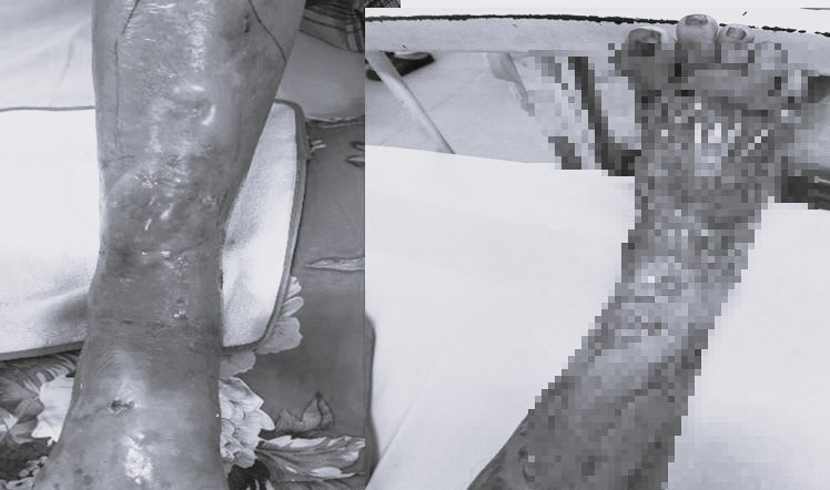 Chân bệnh nhân phỏng rộp, hoại tử sau tiếp xúc với kiến ba khoang. Ảnh: Bệnh viện cung cấp.