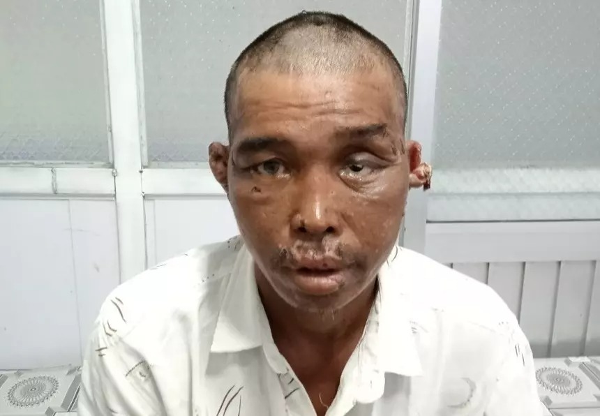 Ông Trung chi chít vết thương với tỷ lệ thương tích 48%