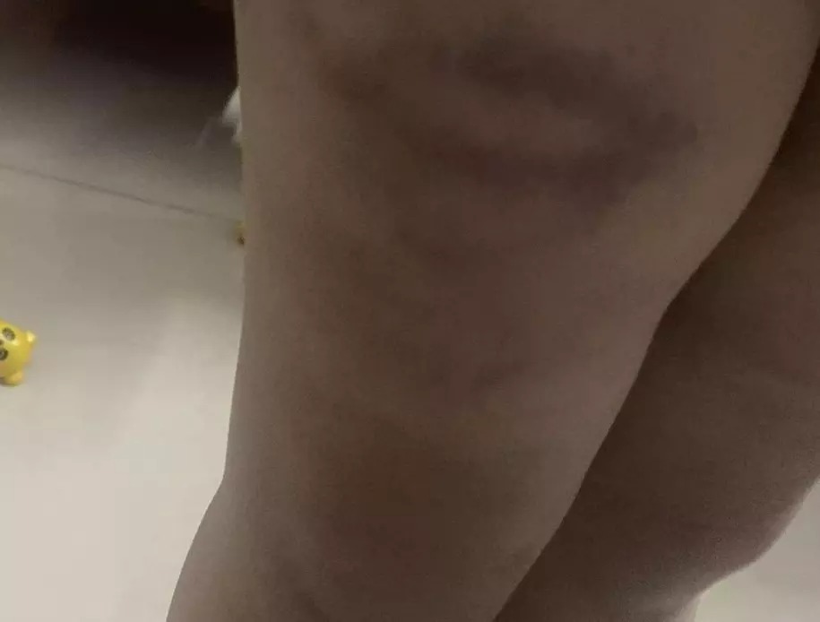 Phần chân cũng xuất hiện những vết bầm tương tự