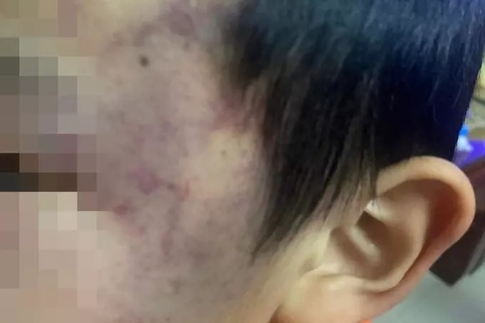 Vết bầm tím trên mặt cháu bé