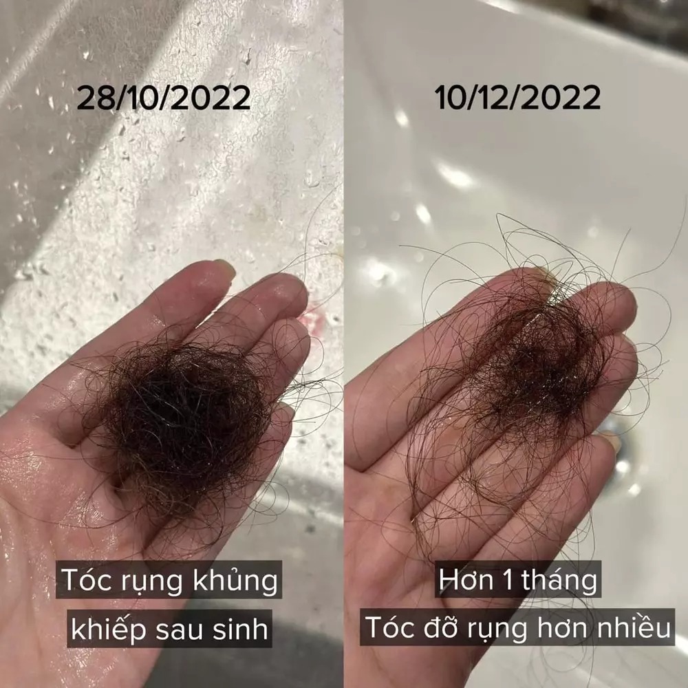 Cách đây không lâu, Phanh Lee còn gây chú ý khi tiết lộ cô bị ám ảnh, mệt mỏi về việc rụng tóc sau sinh. Nhìn hình ảnh nắm tóc rụng ai cũng xót vì quá nhiều. 