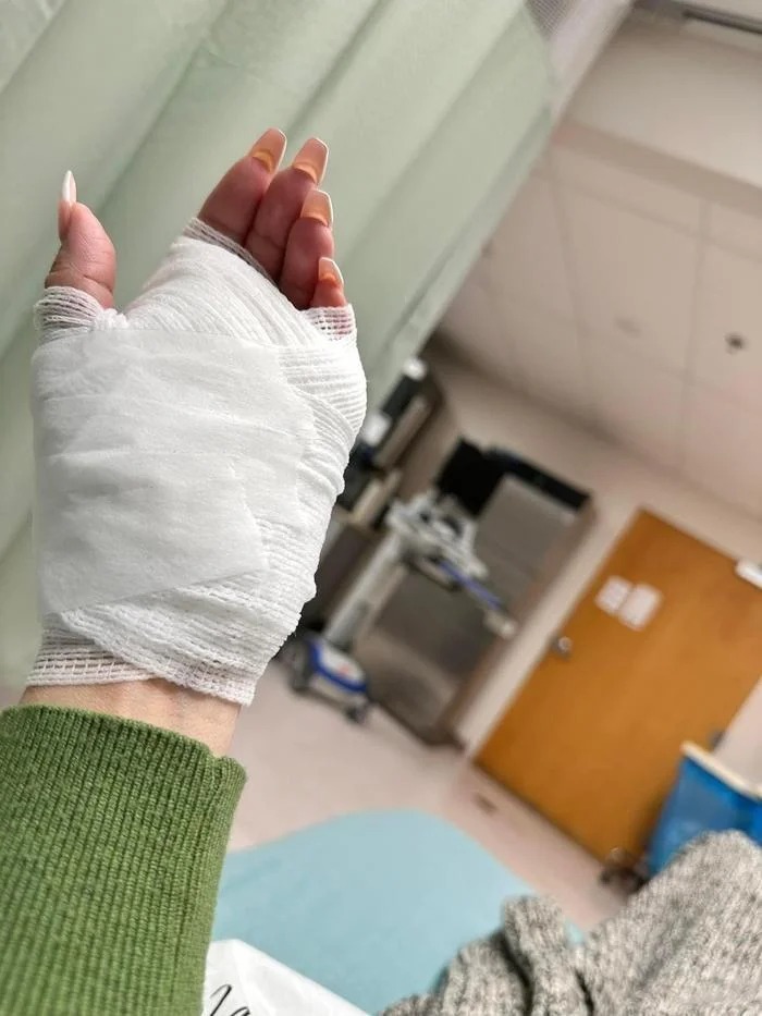 Cánh tay gặp tai nạn hồi đầu năm của vợ cũ Bằng Kiều.