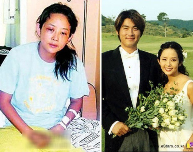 Hình ảnh Choi Jin Sil bị chồng bạo hành gây sốc dư luận