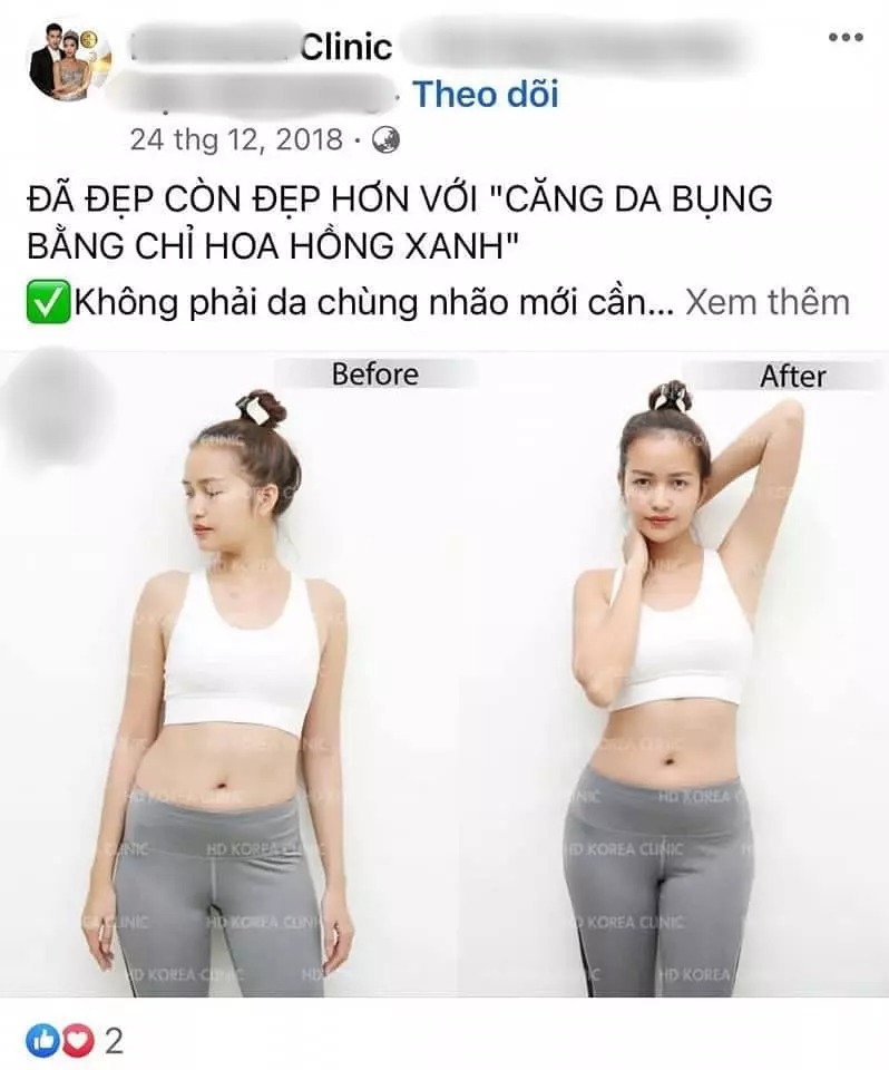 Tuy nhiên phe còn lại thì khẳng định dù có là tiêm filler, nâng chỉ đều bị tính là có thẩm mỹ và nhan sắc của Ngọc Châu ngày càng thiếu tự nhiên vì can thiệp quá đà.